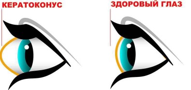 [Людмила Лазарева] Убираем кератоконус. Возвращаем_0.jpg